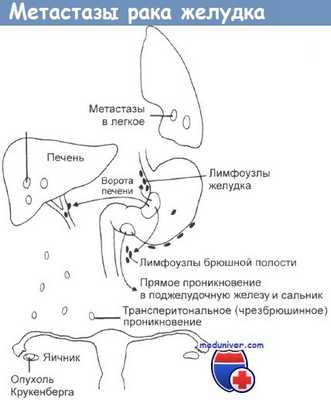 Метастазы рака желудка