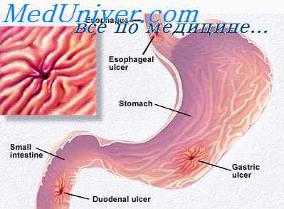 рак желудка