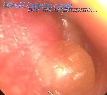 средний отит