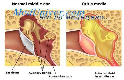 средний отит