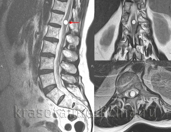 МРТ поясничного отдела позвоночника. Кистозное включение в толще спинного мозга (сирингомиелия)