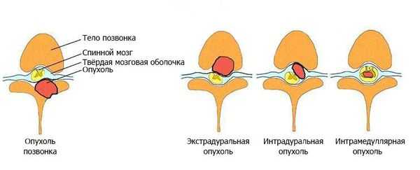 Виды опухолей спинного мозга