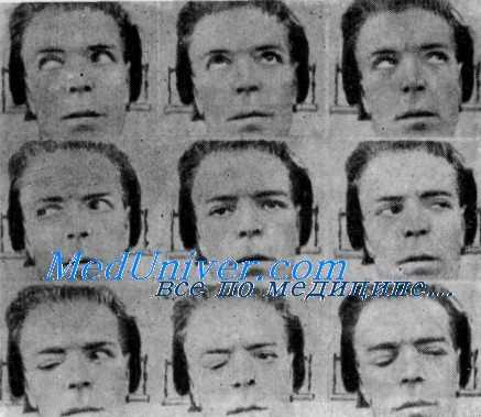 регенерация глазодвигательного нерва