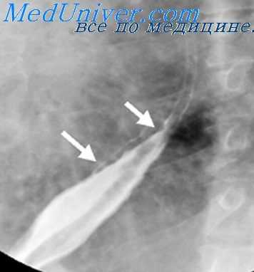 сужения пищевода