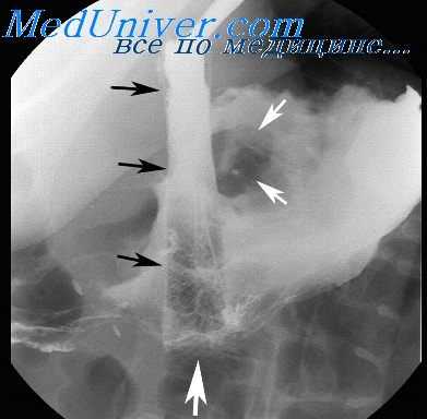 просвет пищевода