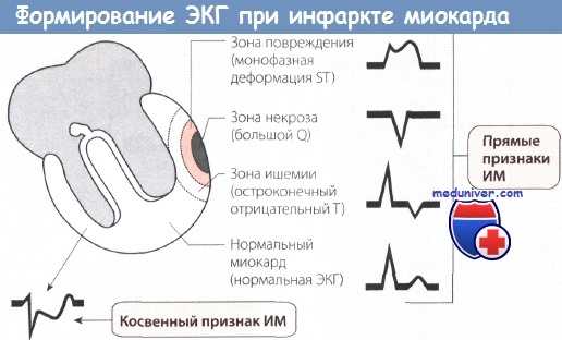 патологический зубец q при инфаркте миокарда