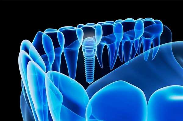 Воспаление и другие осложнения при приживлении импланта