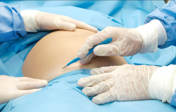 Кесарево сечение