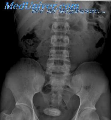 деструктивные болезни кишечника