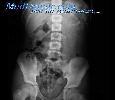 патология кишечника