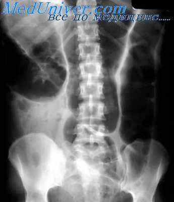 дивертикулы кишечника