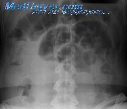 перистальтика кишечника