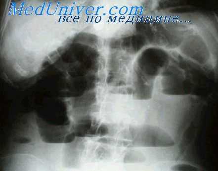 барий на снимках