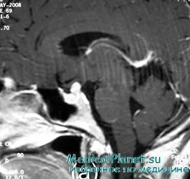патанатомия болезни симмондса