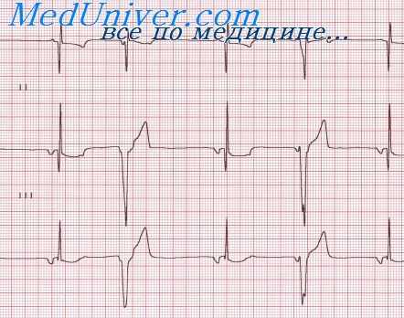 триггерные аритмии