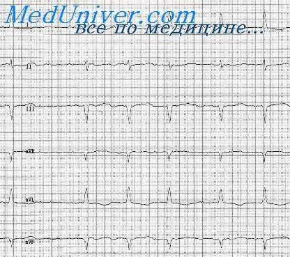 триггерная активность