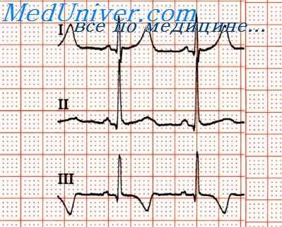 тахиаритмии