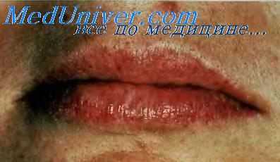 Болезнь Рандю—Вебера—Ослера