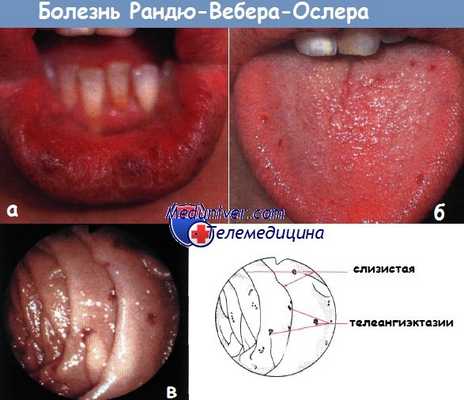 Болезнь Рандю-Вебера-Ослера