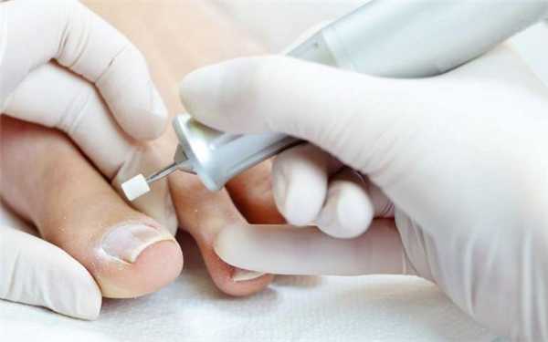 Медицинский педикюр для вросшего ногтя