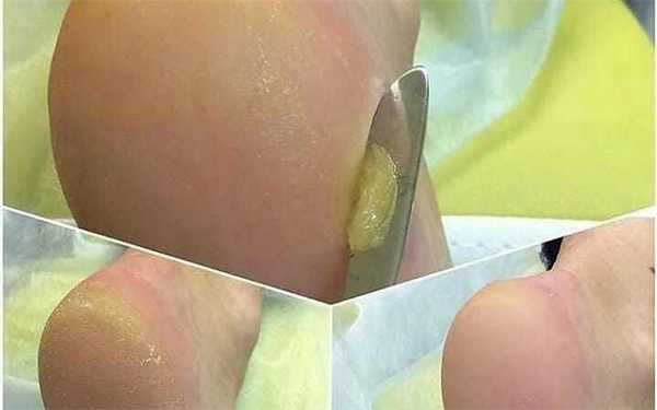 Атравматический препаратный педикюр