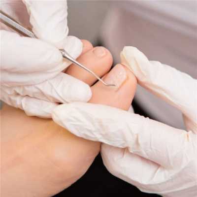 Как убрать птеригий на ногтях ног