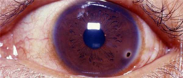 Ранения глаза