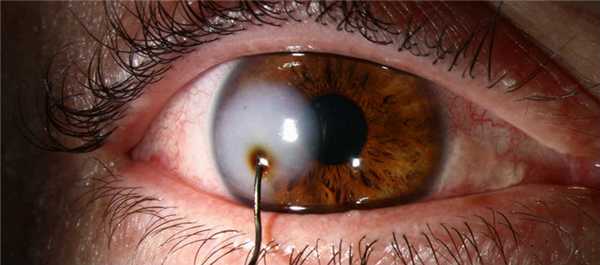 Ранения глазного яблока