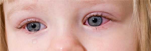 Воспаление глаза причины