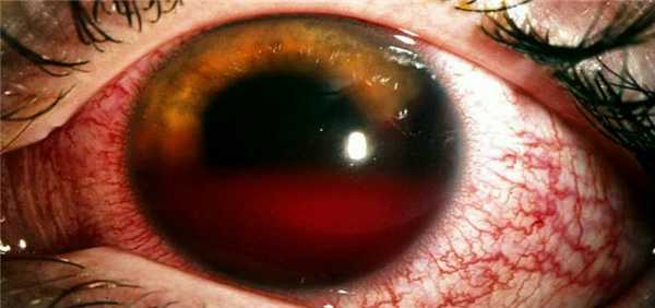 Проникающие ранения глазного яблока