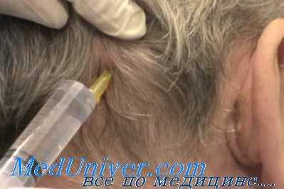 субокципитальная пукнция