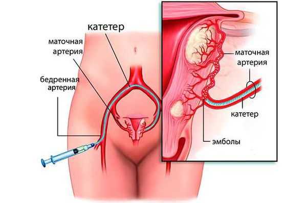 Метод эмболизации маточных артерий (ЭМА) 