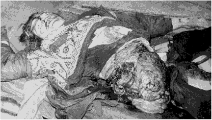 Травматическая эвисцерация органов брюшной полости при переезде колеса через область живота