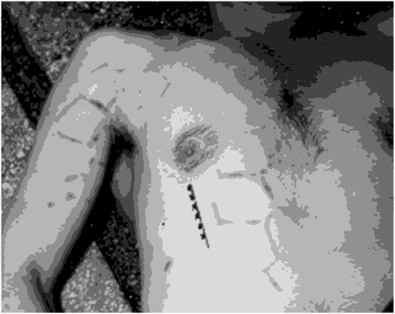 Кровоподтеки на теле в форме отпечатка протектора после перекатывания колеса