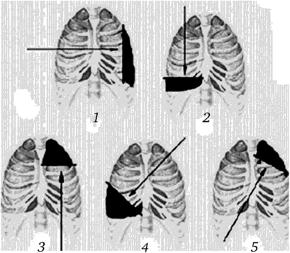 Расположение полосы буллезной эмфиземы при различных направлениях переезда колеса через грудную клетку