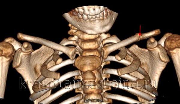КТ грудной клетки. Перелом левой ключицы в средней трети с признаками начавшейся консолидации.