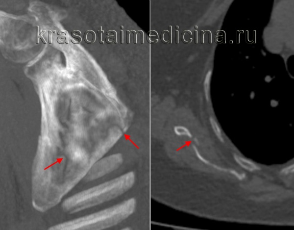 Перелом большого бугорка плечевой кости