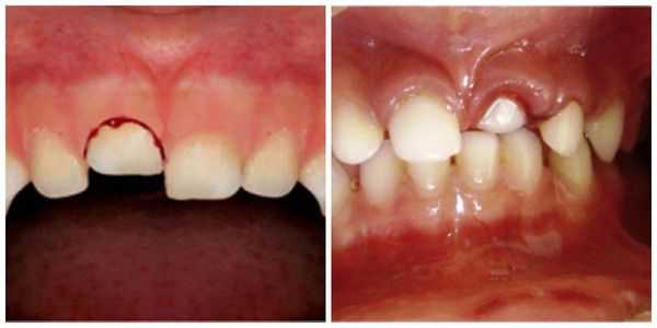 Вколоченный вывих зуба