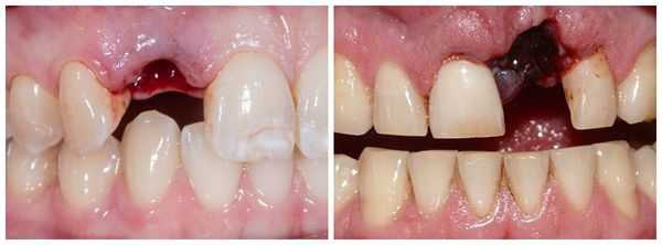 Полный вывих зуба