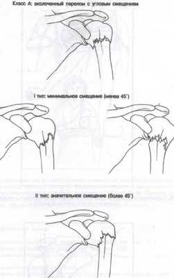 перелом хирургической шейки плечевой кости