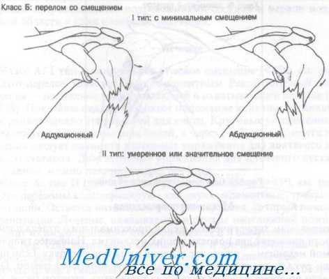 перелом хирургической шейки плечевой кости