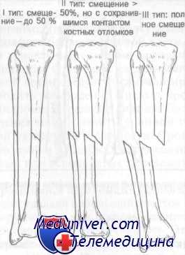 перелом костей голени