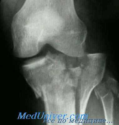 перелом мыщелков большеберцовой кости