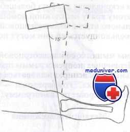 перелом мыщелков большеберцовой кости