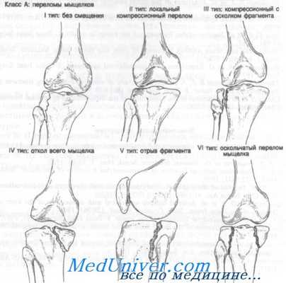 перелом мыщелков большеберцовой кости