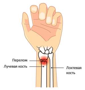 Перелом лучевой кости