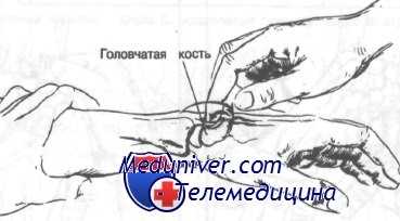 переломы костей запястья