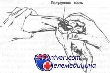 переломы костей запястья