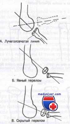 перелом головки и шейки лучевой кости