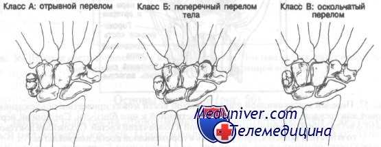 переломы костей запястья